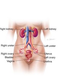 Kidney Stones in Women