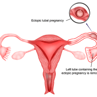 Laparoscopic Ectopic Pregnancy Surgery