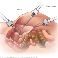 Laparoscopic Oophorectomy