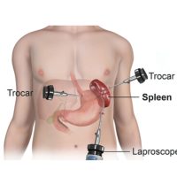 Laparoscopic Splenectomy