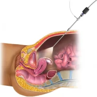 Laparoscopic Treatment of Infertility