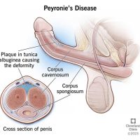 Peyronie's Disease Management