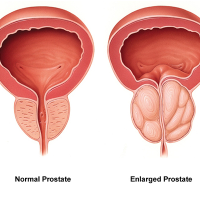 Prostate Cancer Diagnosis and Treatment