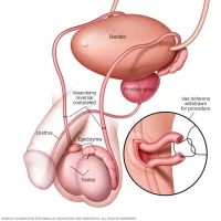 Vasectomy and Vasectomy Reversal