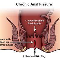 anal_fissure
