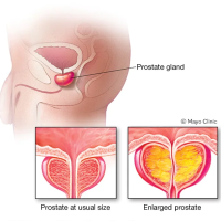 prostate_enlargement copy