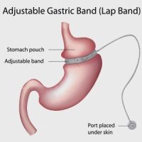 weight-loss-surgery-laparoscopic-adjustable-gastric-banding