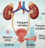 What Are the Symptoms of Urinary Tract Cancer