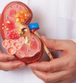Best Non-Surgical Kidney Stone Treatment