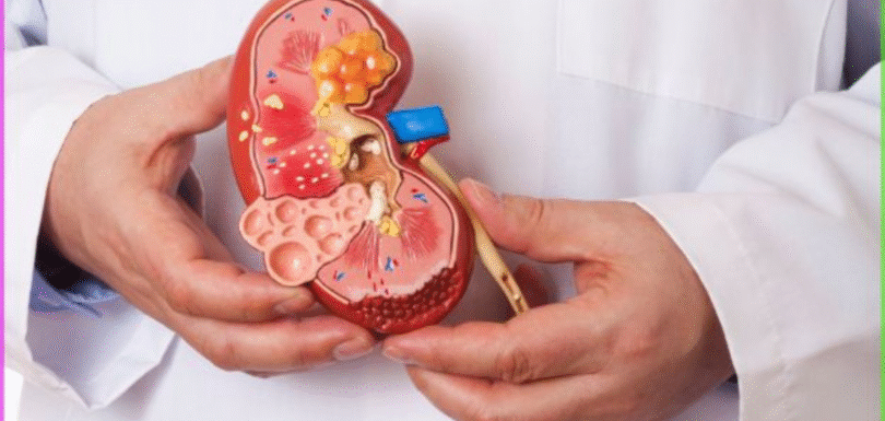 Best Non-Surgical Kidney Stone Treatment