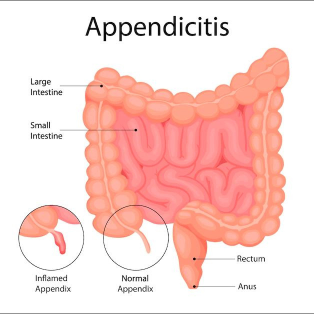 Appendix Surgery Cost in India: Complete Guide to Treatment & Recovery | ILSS – Ashwani Hospital