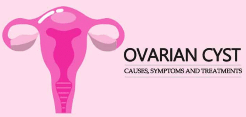 Best Ovarian Cyst Treatment in India - Surgery and Treatment | ILSS Hospital